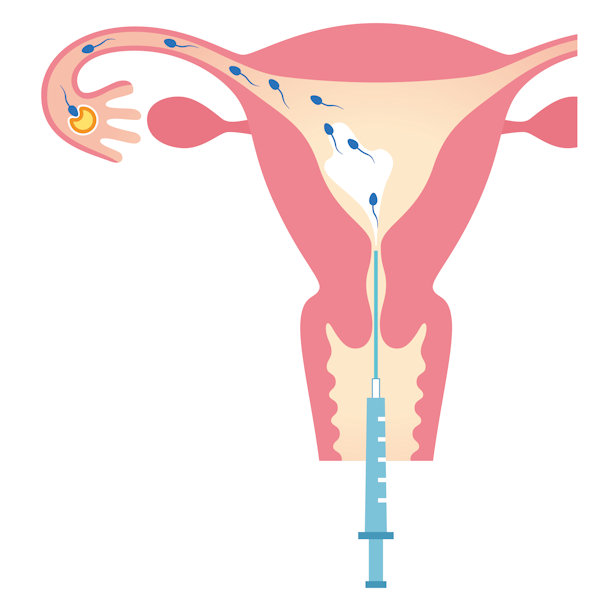 L’insémination intra utérine (IIU)